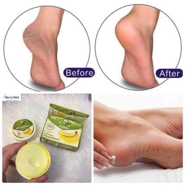 Kem trị nứt chân banana heel cream