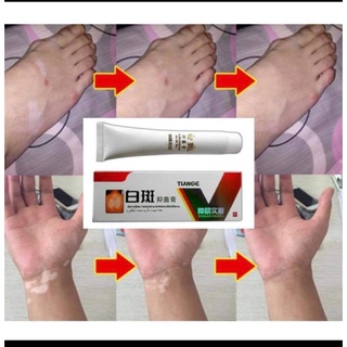 thảo dược bôi bạch biến