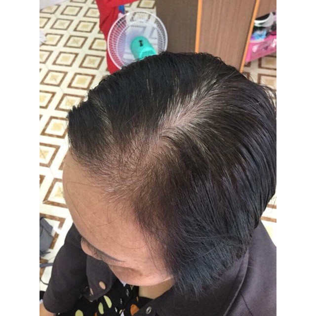 Tóc che hói đỉnh đầu có da đầu mái thưa- tóc cao cấp