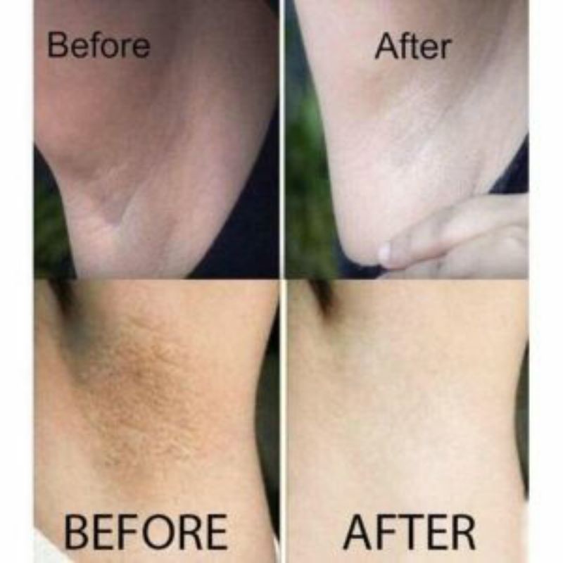 Nuwhite H6 thâm nách ,bẹn, mông