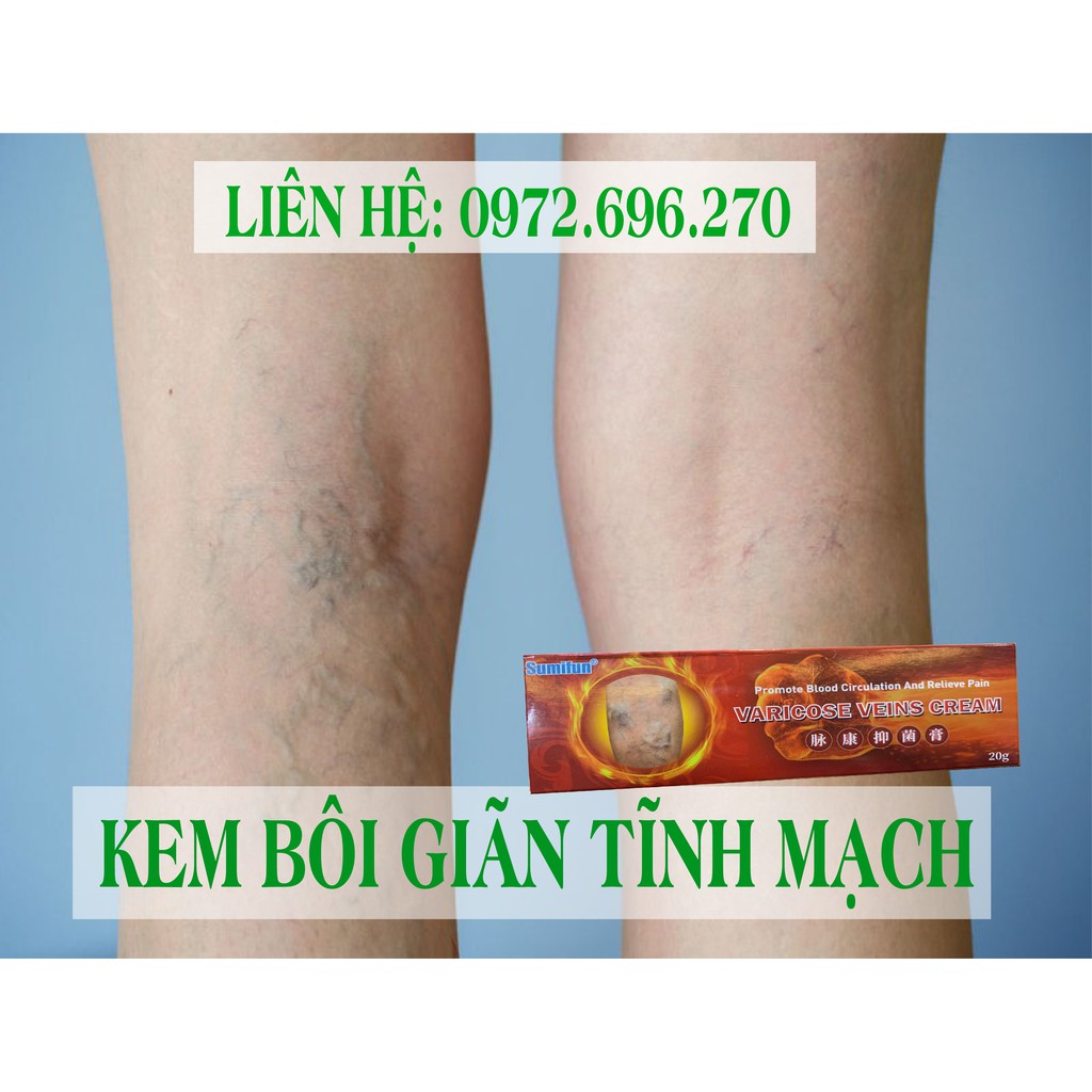 Kem bôi giãn tĩnh mạch Sumifun [ Cực hiệu quả ]