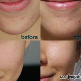 GEL CHẤM MỤN 𝑶𝒓𝒊𝒈𝒊𝒏𝒔 𝑺𝒖𝒑𝒆𝒓 𝑺𝒑𝒐𝒕 𝑹𝒆𝒎𝒐𝒗𝒆𝒓