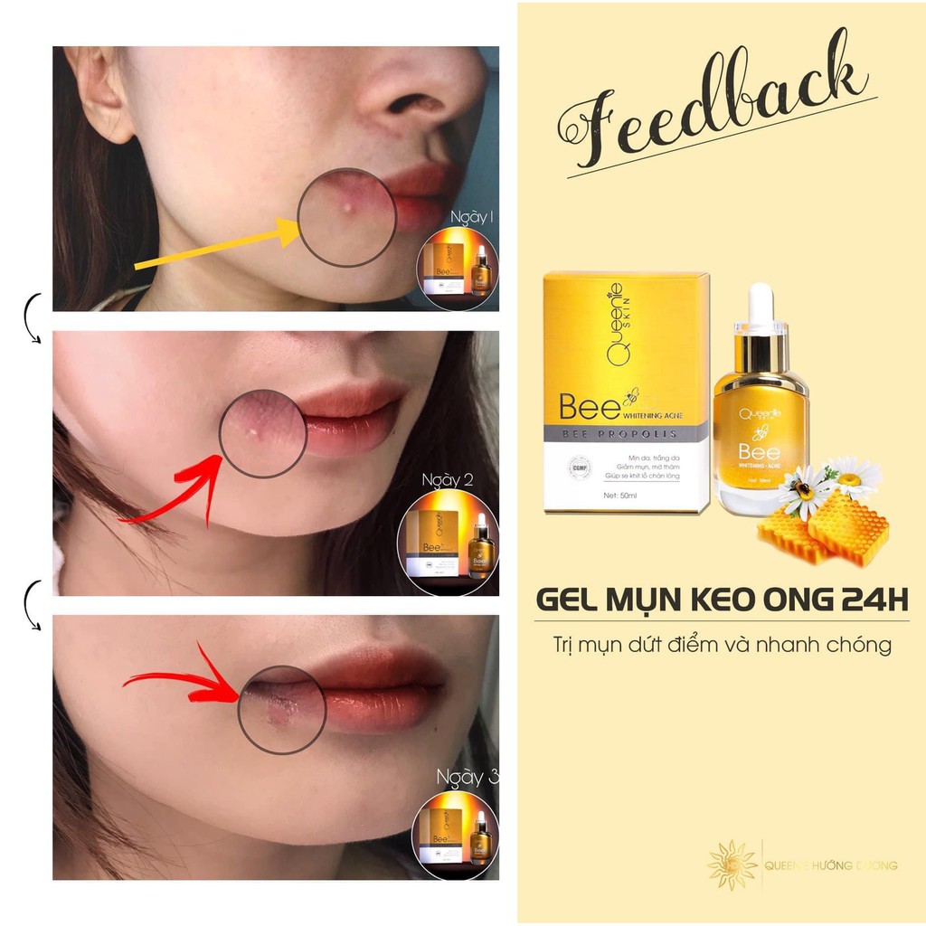 GEL MỤN KEO ONG | BigBuy360 - bigbuy360.vn