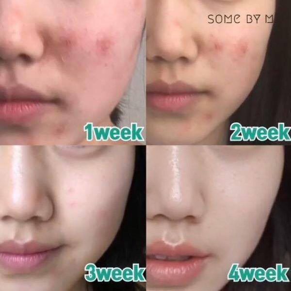 Bộ 3 Sản Phẩm Giảm Mụn, Phục Hồi Da Some By Mi AHA-BHA-PHA 30 Days Miracle (SRM 100ml &amp; Toner 150ml &amp; Serum 50ml)