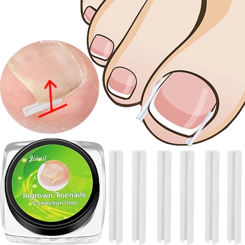 Bộ 10 Miếng Dán Chỉnh Sửa Móng Chân Mọc Ngược Tiện Lợi
