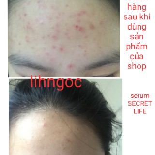 (💥CHÍNH HÃNG) Serum trị mụn Secret Life (hàng sẵn có).