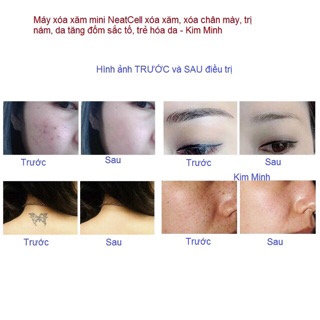 Máy xoá hình xăm laser mini neat cell