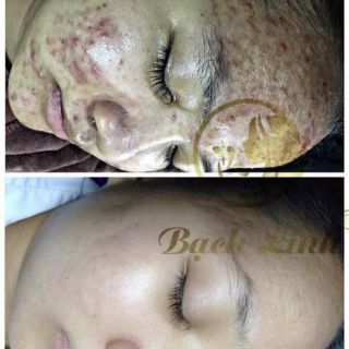 THUỐC THAY DA BẠCH LINH 02. CHUYÊN MỤN