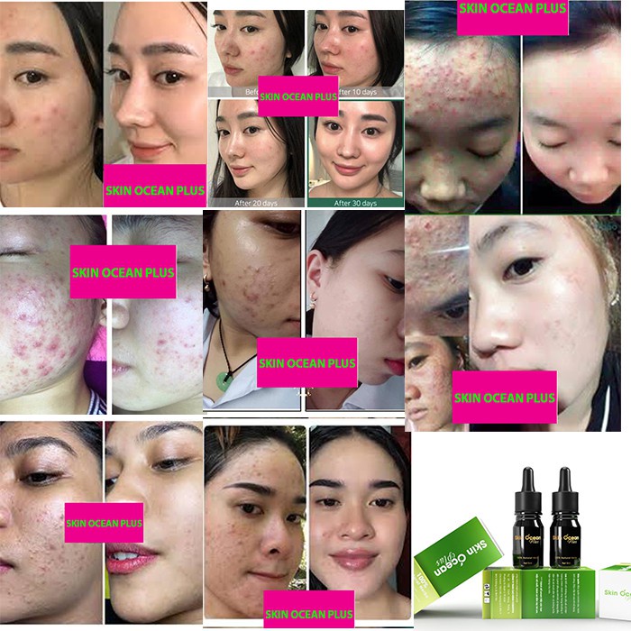 [DR MAI] KEM MỤN SKIN OCEAN PLUS DA TRẮNG KHÔNG TÌ VẾT, KHÔNG CÒN NỔI LO VỀ MỤN | BigBuy360 - bigbuy360.vn