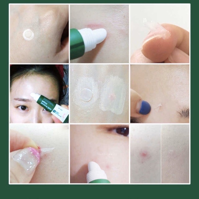 GEL DÁN MỤN PRRETI SECOND SKIN PATCH | BigBuy360 - bigbuy360.vn