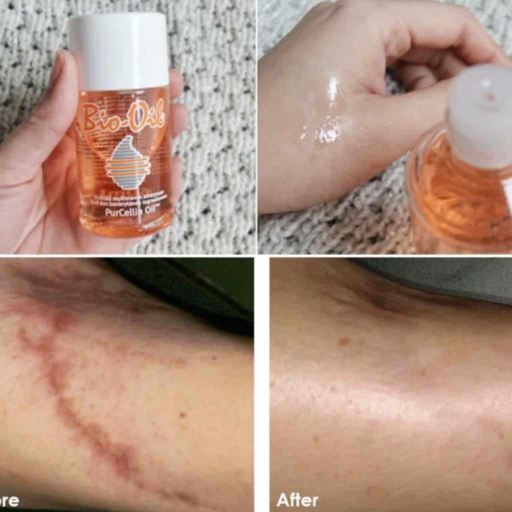 Tinh dầu chống rạn da bà bầu bio oil scar làm hết rạn da mờ sẹo hết thâm da khi mang thai và sau sinh.