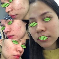 Serum Loại Bỏ Mụn Detox Blanc