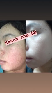 Tái tạo da BB