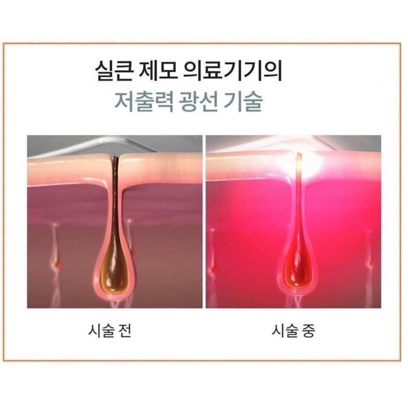 Máy triệt lông Intense pulsed light Kakkuda Hàn Quốc  Máy triệt lông HALINCOS564