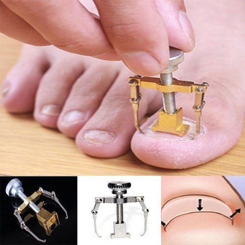Dụng Cụ Chỉnh Hình Móng Chân Mọc Ngược Móng Quặp