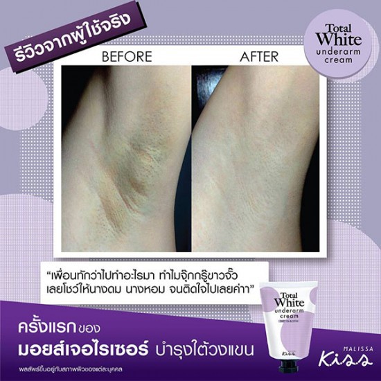 [Auth Thái] Kem Giảm Thâm  Nách Malissa Kiss Total White Underarm Cream