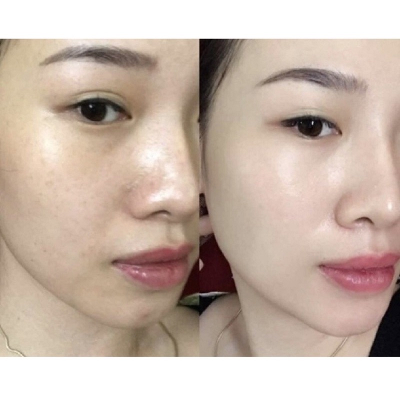 TRẮNG DA GLUTATHIONE 1000 MỚI VIÊN UỐNG ĐẸP DA GIẢM NÁM NÂNG TÔNG TỨC THÌ