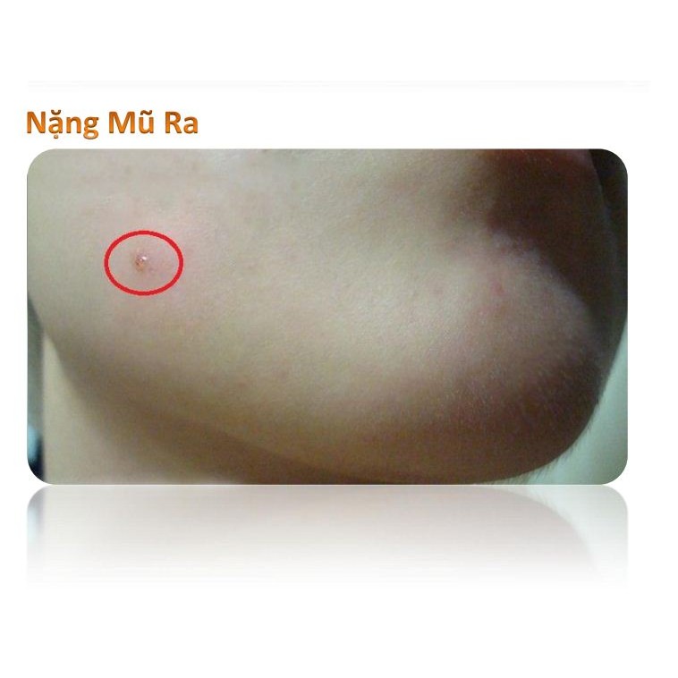 Miếng dán mụn hydrocolloid Somaderm Spot Pimple Patch 24 miếng 3 kích cỡ - MẪU MỚI HỘP XANH | BigBuy360 - bigbuy360.vn