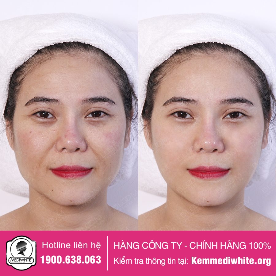 Kem Chống Lão Hóa Medi White Chính Hãng - Medi Aging - Kem Chống Lão Hóa Mờ Nếp Nhăn Medi White - Hàng Công Ty