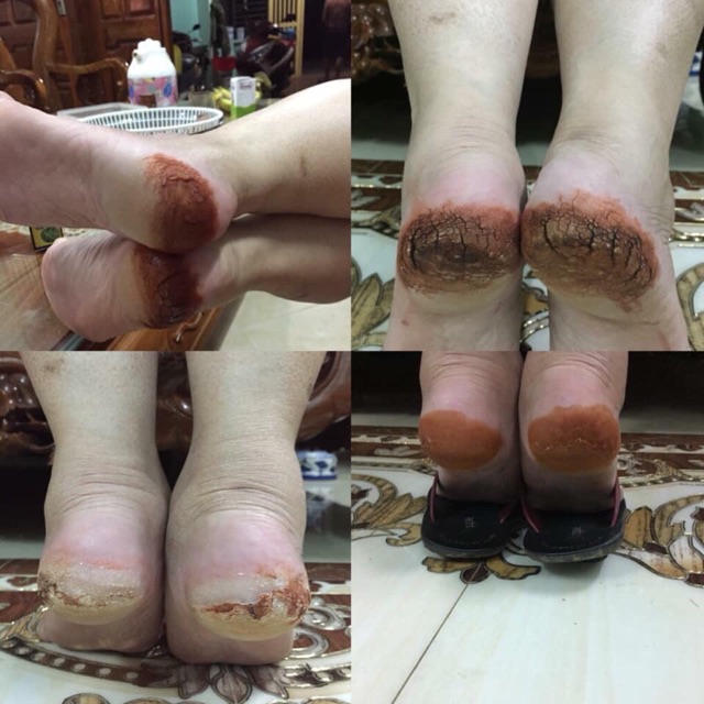 [CỰC HIỆU QUẢ] Bôi Hỗ Trợ Á Sừng Tổ Đỉa Nấm Nứt Gót Chân Hắc Lào | BigBuy360 - bigbuy360.vn