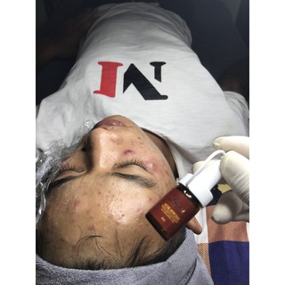SERUM ACNE AMPOULE DNA CÁ HỒI (LOẠI BỎ MỤN TẬN GỐC)