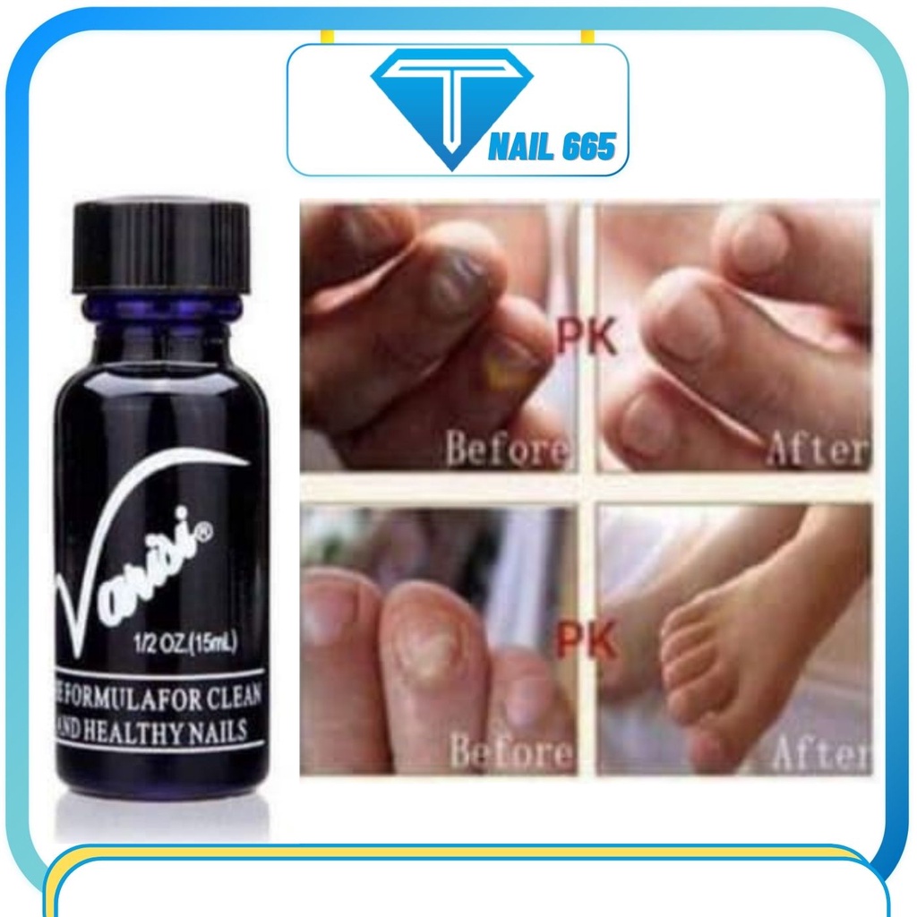 Dưỡng móng chống nấm móng tay nail , Kem bôi Nấm móng chân tay VIRASI