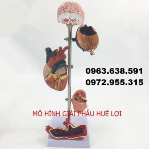 MÔ HÌNH BIẾN CHỨNG CỦA TĂNG HUYẾT ÁP