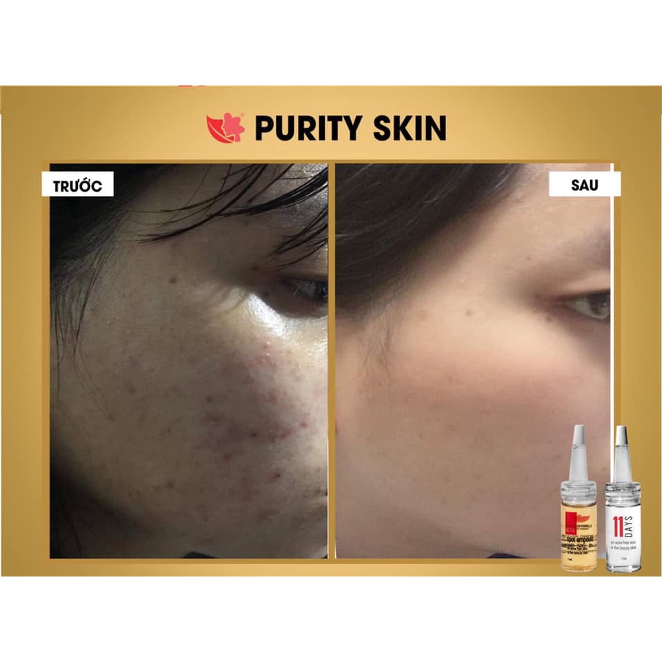 Bộ Serum mụn Linh Hương Purity Skin 11ml đánh bay mụn hết thâm làm mịn da hiệu quả trong 11 ngày