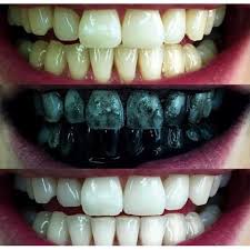 Than hoạt tính đánh răng Teeth whitening,than hoạt tính tẩy trắng răng