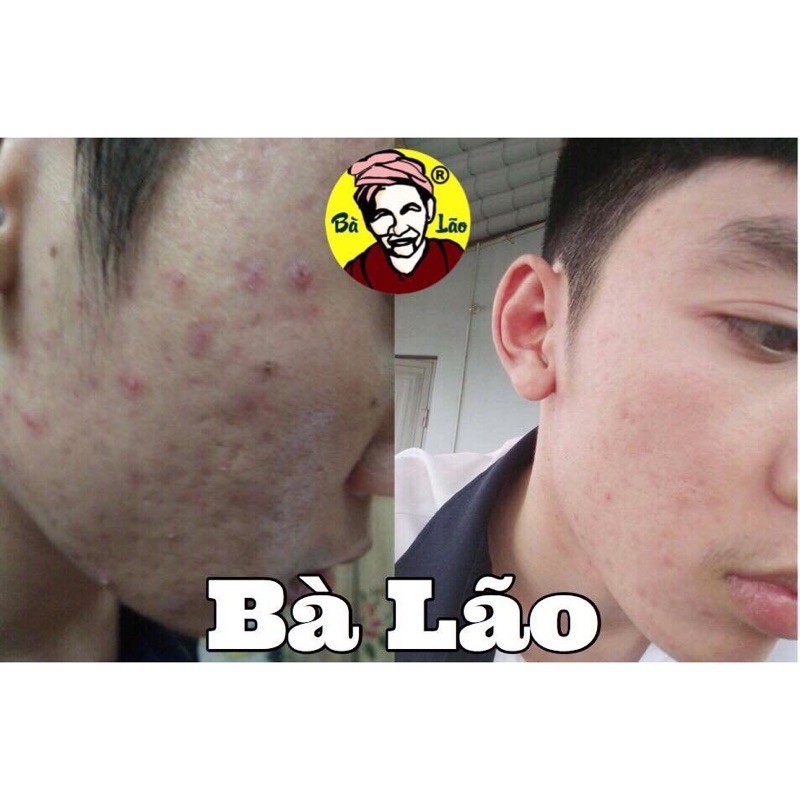 Serum Mụn - Sẹo - Nám Da cao cấp - Bà Lão