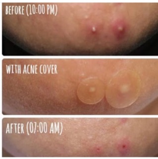 Miếng dán mụn Cosrx Master