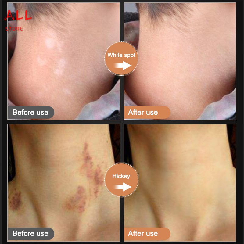 (Hàng Mới Về) Kem Che Khuyết Điểm Hình Xăm / Sẹo 2 Tông Màu Chống Nước | BigBuy360 - bigbuy360.vn