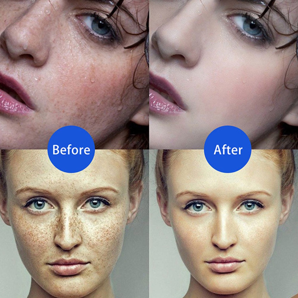 Bút Laser Loại Bỏ Nốt Ruồi / Tàn Nhang / Đốm Đen Trên Da Tiện Dụng