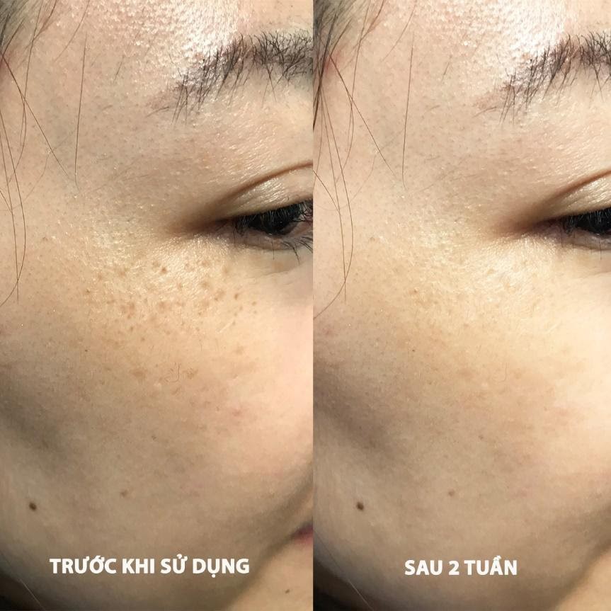 Tinh Chất Giảm Nám Eucerin Ultra White+ Spotless Spot Corrector