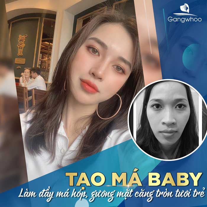 Dịch vụ tạo má Baby tại Gangwhoo