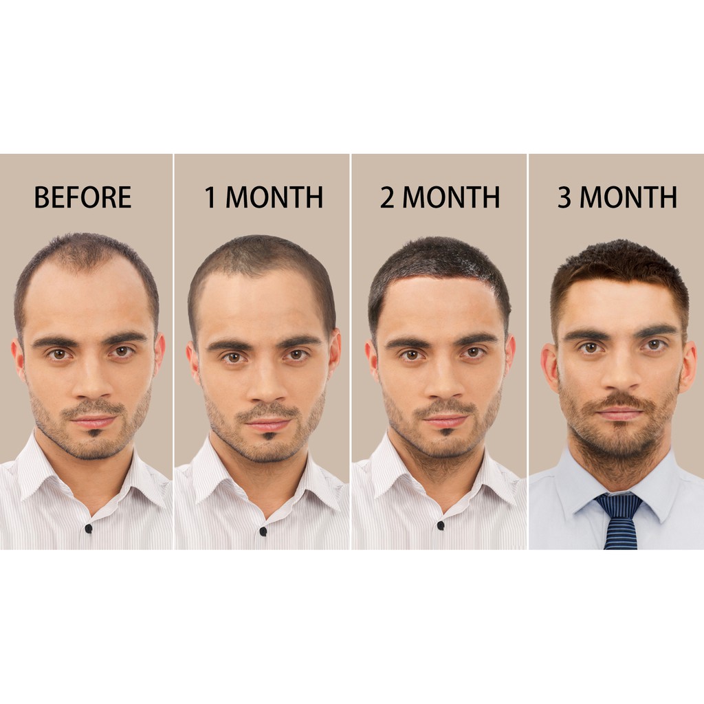 Chai Xịt Kích Thích Mọc Tóc PURC Kiểu Dáng Tiện Dụng 30ML | BigBuy360 - bigbuy360.vn