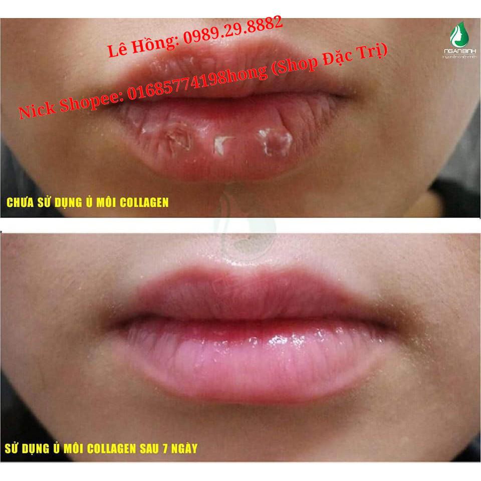 Ủ MÔI Collagen Ngân Bình 5g: Dưỡng MÔI KHÔ NỨT NẺ, Khử MÔI THÂM BONG TRÓC, LÀM HỒNG MÔI, HỒNG NHŨ HOA Mặt nạ ngủ cho môi | BigBuy360 - bigbuy360.vn