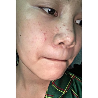 Tri Mụn Thâm Dr Mai