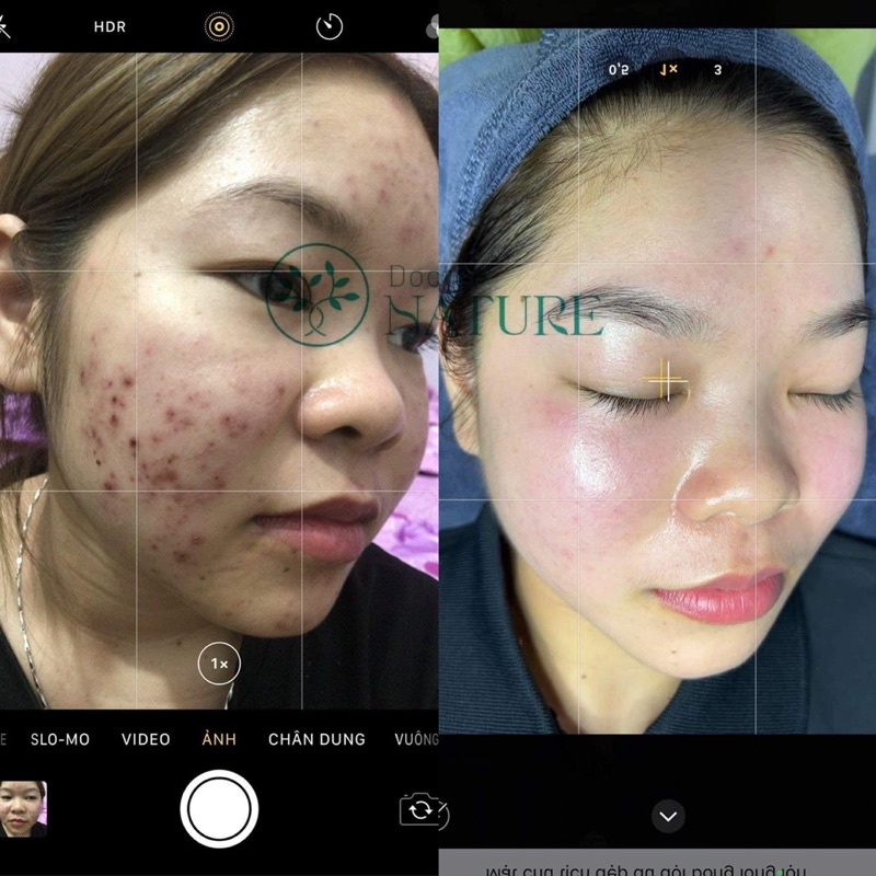 ACNES NGỪA MỤN DOCTOR NATURE  x5 lần hiệu quả,ngừa các loại mụn,thâm,sáng da,nho lcl,khoẻ căng bóng da,..
