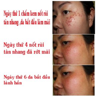 Kem Xóa Nốt Ruồi Mụn Thịt Tàn Nhang