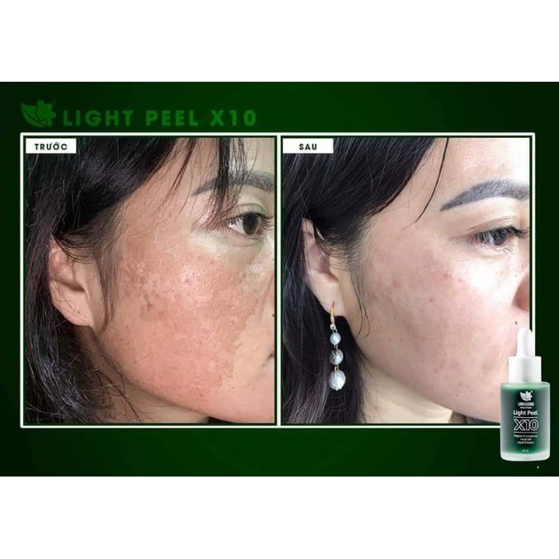 PEEL DA GIẢM NÁM, GIẢM MỤN, TRẺ HÓA DA[CHÍNH HÃNG] | BigBuy360 - bigbuy360.vn