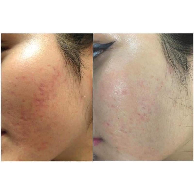 Kem Skarfix - TX 15g mờ thâm mụn, mờ nám tàn nhang, giúp sáng da sáng mịn và đều màu 💋💋 | BigBuy360 - bigbuy360.vn