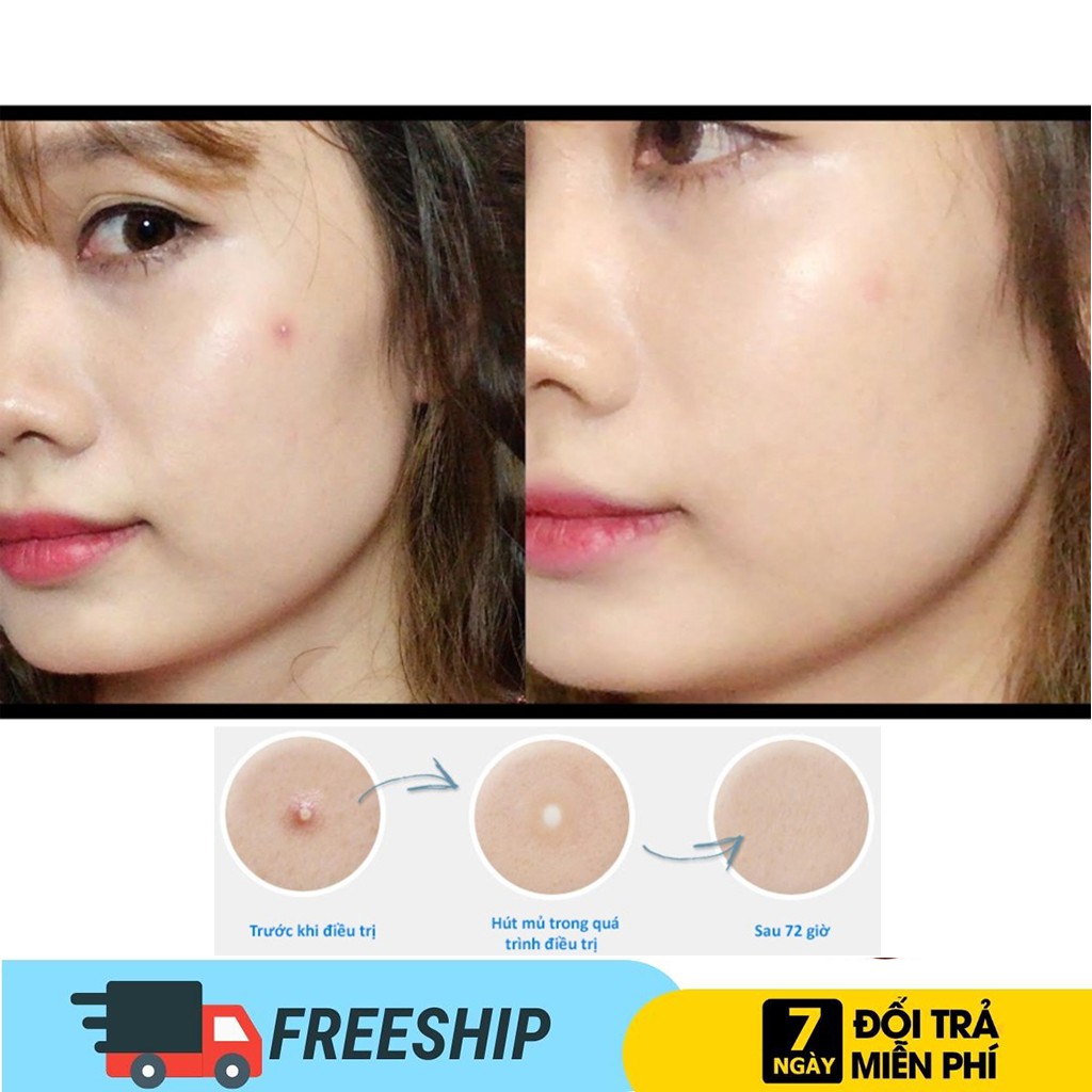 Miếng Dán Mụn DM201 Cosrx Miếng dán mụn Acne Pimple Master Patch (20ml)