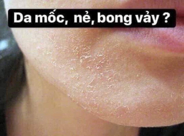 KEM NẺ VASELINE VIỆN BỎNG QUỐC GIA