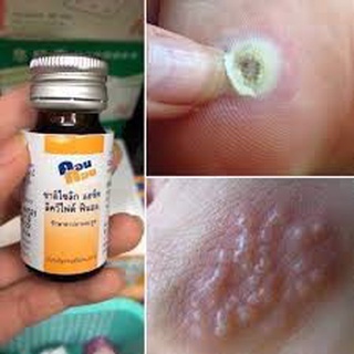Bôi mụn cóc, sủi mào gà Concon thái lan