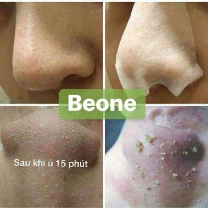 Ủ mụn Youngerc chính hãng chuyên dùng cho spa