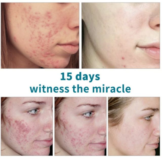 Serum Mụn 12h hiệu quả