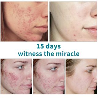 Serum Mụn 12h hiệu quả