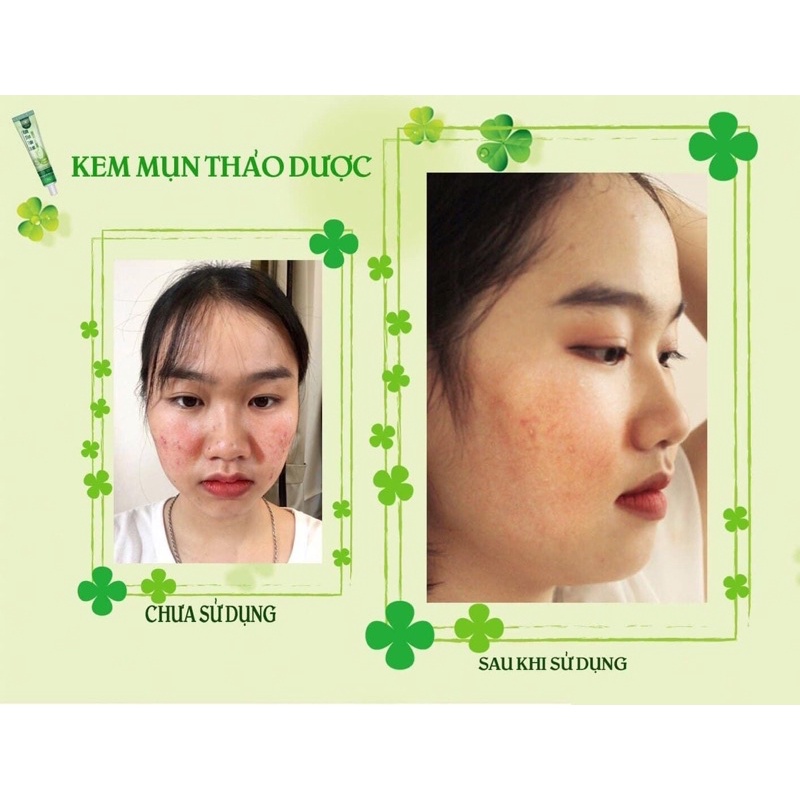 Kem trị_mụn sinori