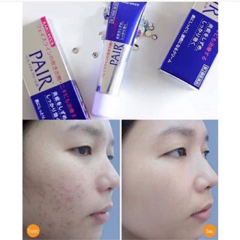 Kem chấm mụn Pair 24g
